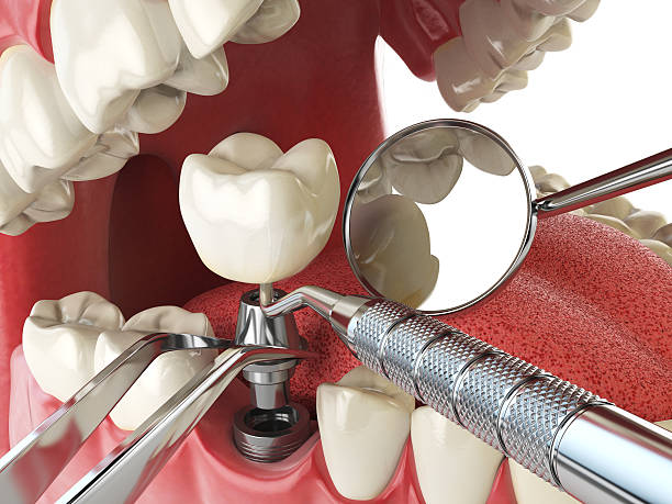 Best Emergency Denture Repair in Highland Beach, FL